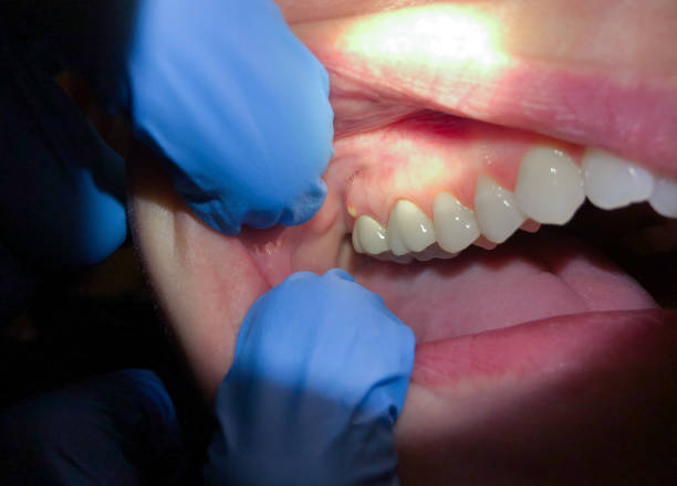 Best Emergency Dental Care for Broken or Chipped Teeth in Newport, DE