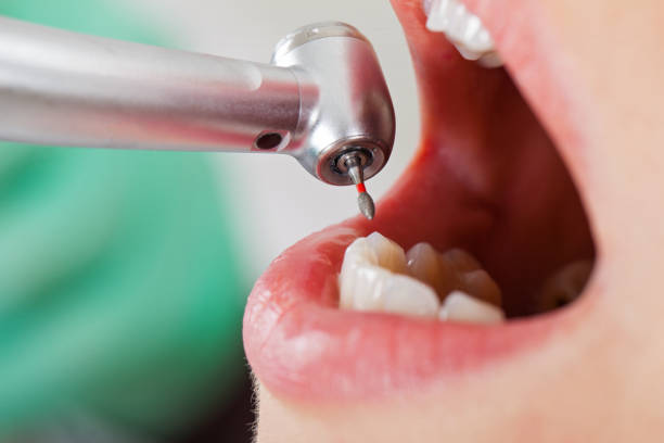 Best Emergency Wisdom Teeth Removal in Newport, DE